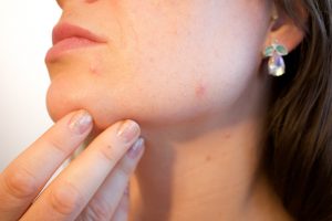 acne scar treatment Newcastle | Honour Health