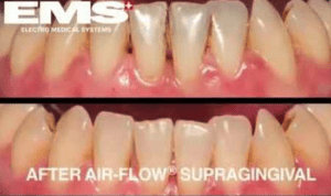 Airflow Newcastle | hygienist Newcastle | Honour Health