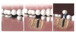 Dental implants Newcastle | Honour Health