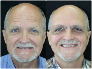 Dental implant treatment before and after photos