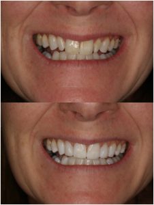 composite veneers - a before and after image. This is a patient at Honour Health in Newcastle.