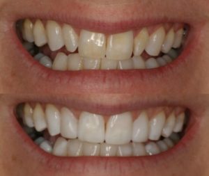 before and after images of composite veneers at Honour Health in Newcastle